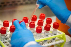Epidemija parazita u SAD-u ne jenjava, za sedam dana na hiljade novih slučajeva
