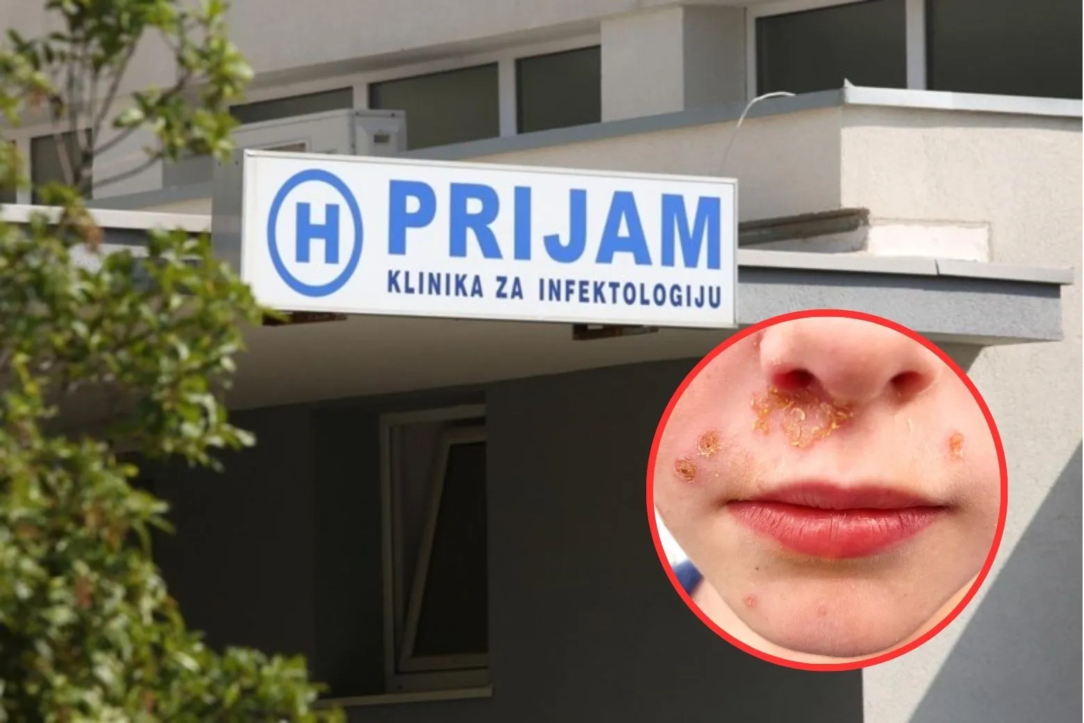 Alarm u Splitu, sve više djece javlja se u ambulante s impetigom: Evo o čemu se radi